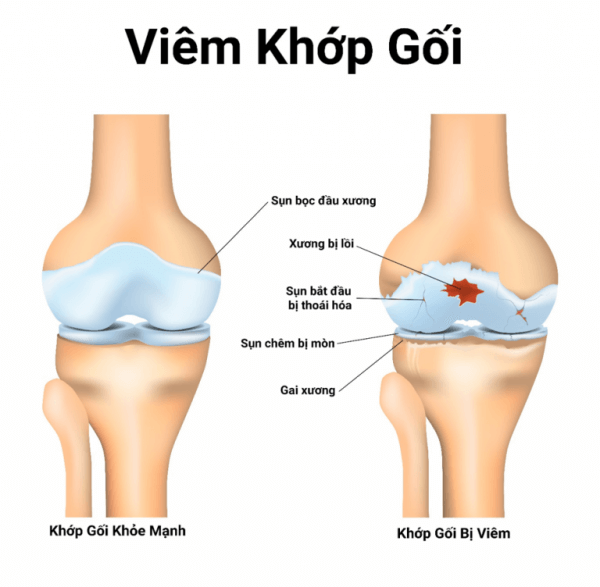 Tình trạng tổn thương của khớp gối khi bị viêm