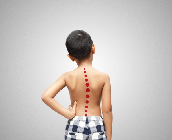 Cột sống bị vẹo ở trẻ nhỏ