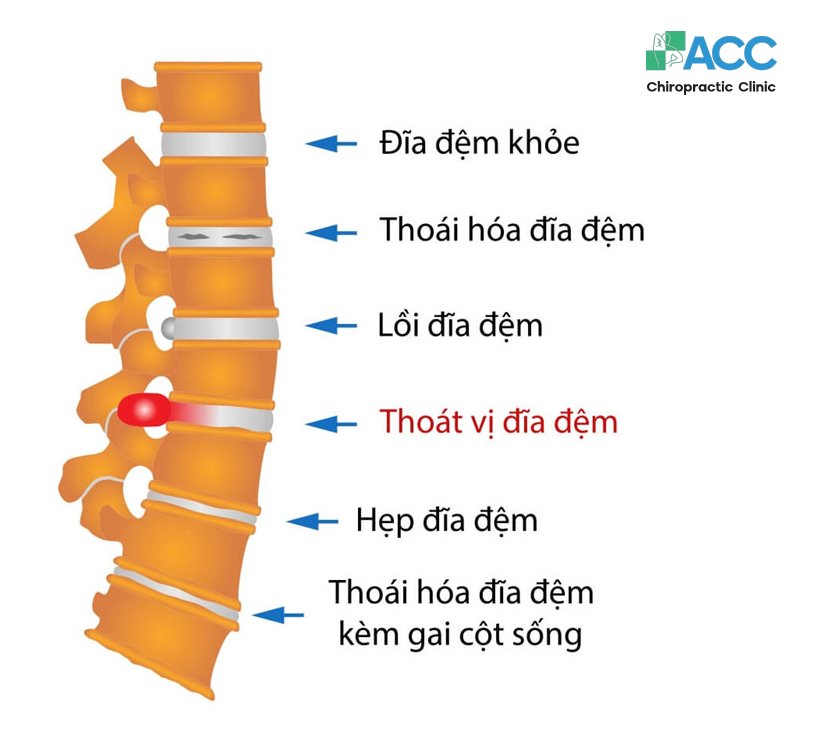 Thoát vị đĩa đệm chèn ép dây thần kinh gây ra các cơn đau.