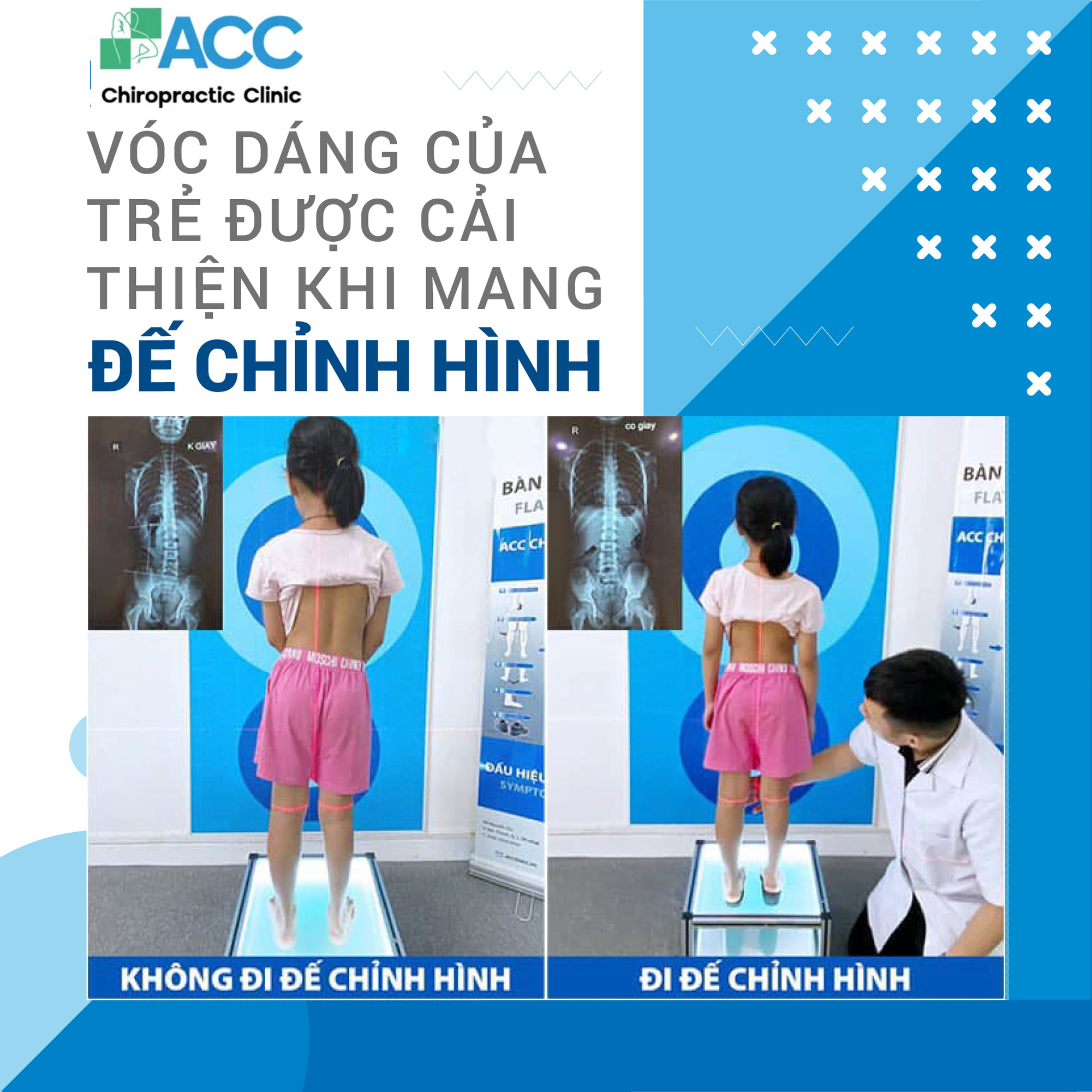  Vóc dáng của bé được cải thiện sau khi mang đế chỉnh hình 