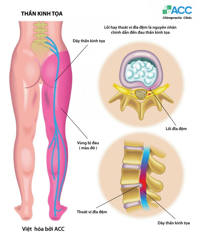 Điều trị đau thần kinh tọa bằng Chiropractic được thực hiện như thế nào?