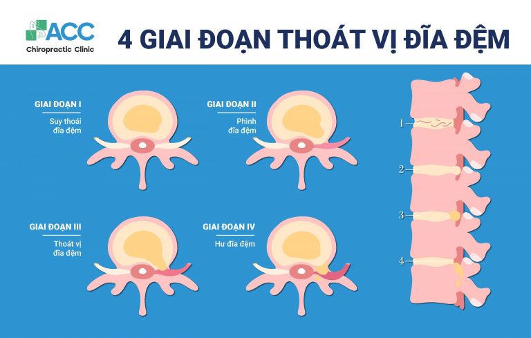 Các giai đoạn tiến triển của thoát vị đĩa đệm